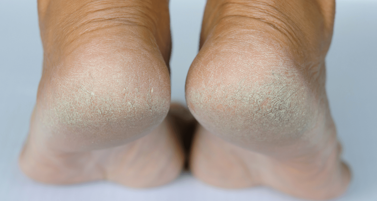 Comment se débarasser de la peau morte des pieds secs?