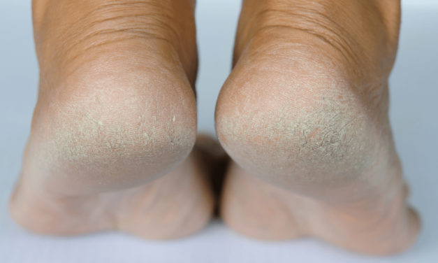 Comment se débarasser de la peau morte des pieds secs?