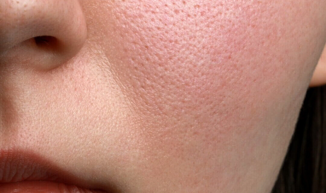 Comment minimiser vos pores dilatés…